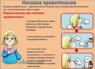 Как быстро остановить кровь из носа у ребенка