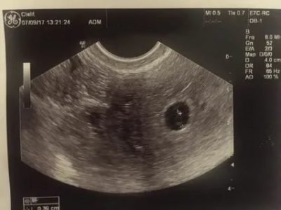 На каком сроке беременности на узи видно эмбрион