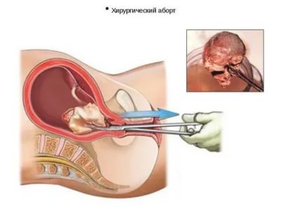 На каком сроке можно делать хирургический аборт