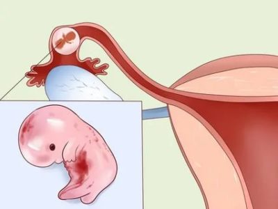 Можно ли забеременеть после внематочной беременности