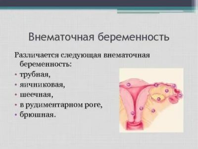 Как может получиться внематочная беременность