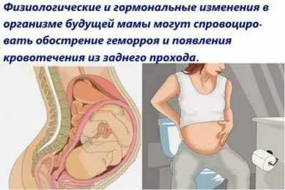 Что такое геморрой при беременности