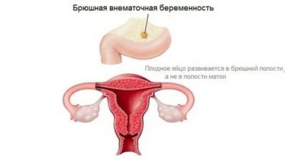 Что такое беременность в брюшной полости